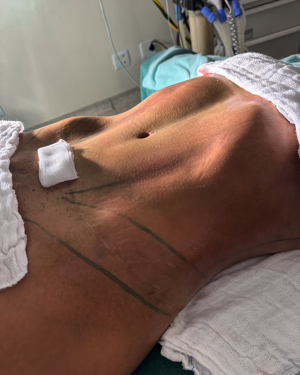 Abdominoplastia