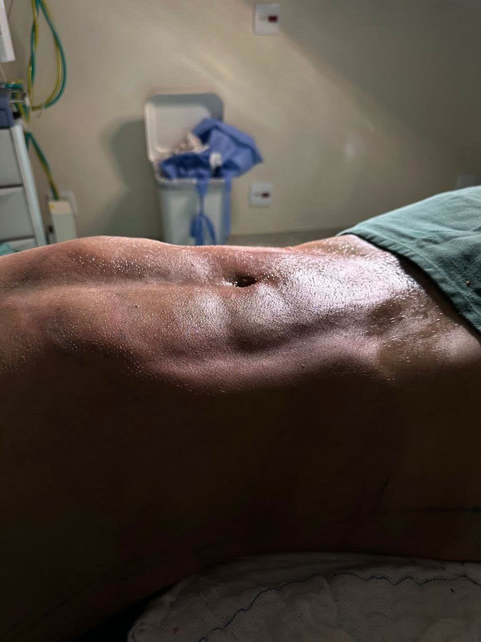 Lipo LAD Ultrassônica