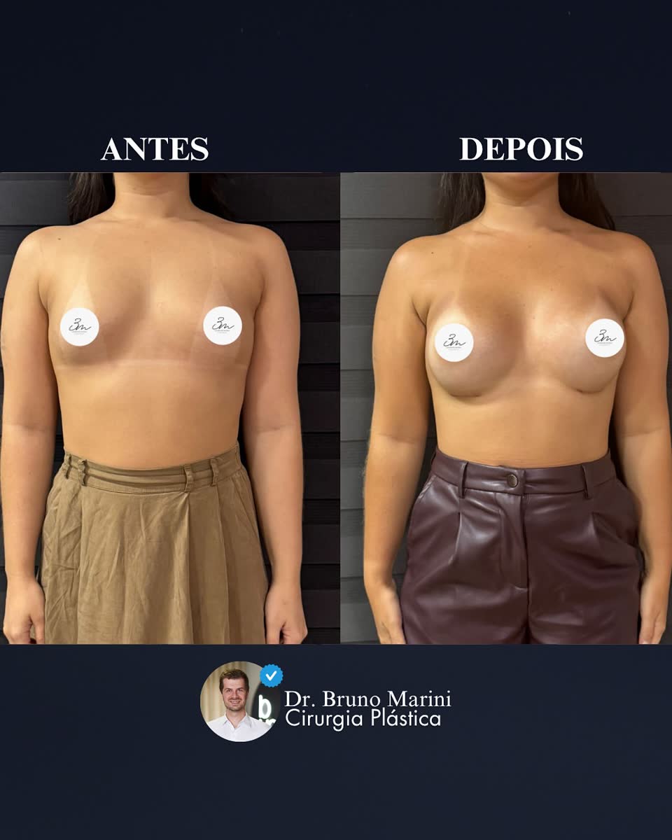 Mamoplastia de Aumento